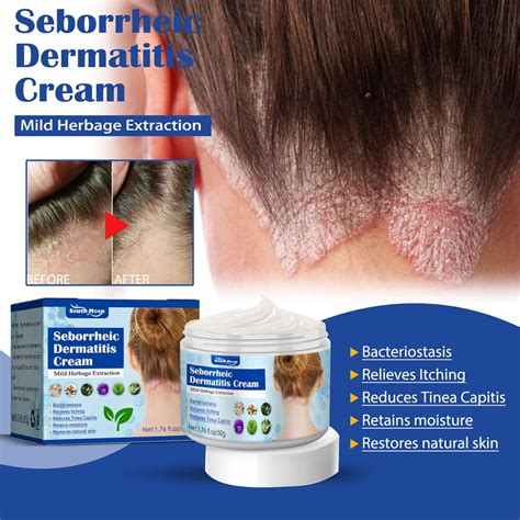 seborrheic dermatitis scalp treatment